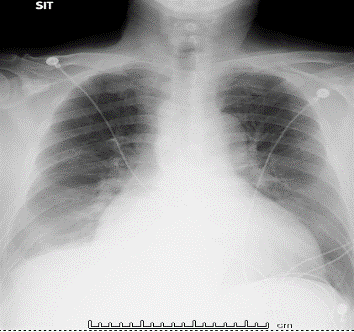 図1　胸部X線画像